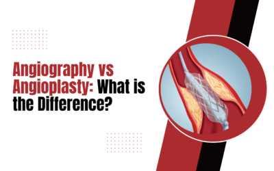 Angiography vs Angioplasty: What is the Difference?