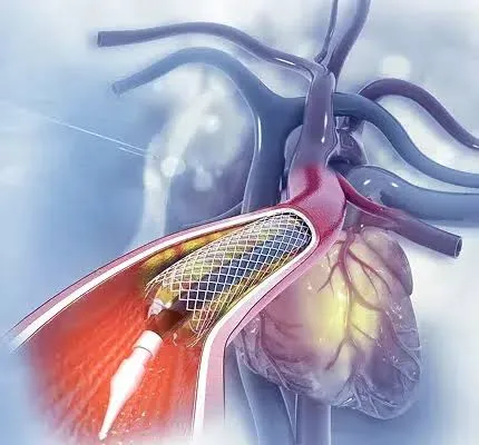 Blocked Heart Arteries – Dr. Kiran Narang