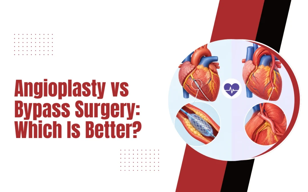 Angioplasty vs Bypass Surgery: Which Is Better?