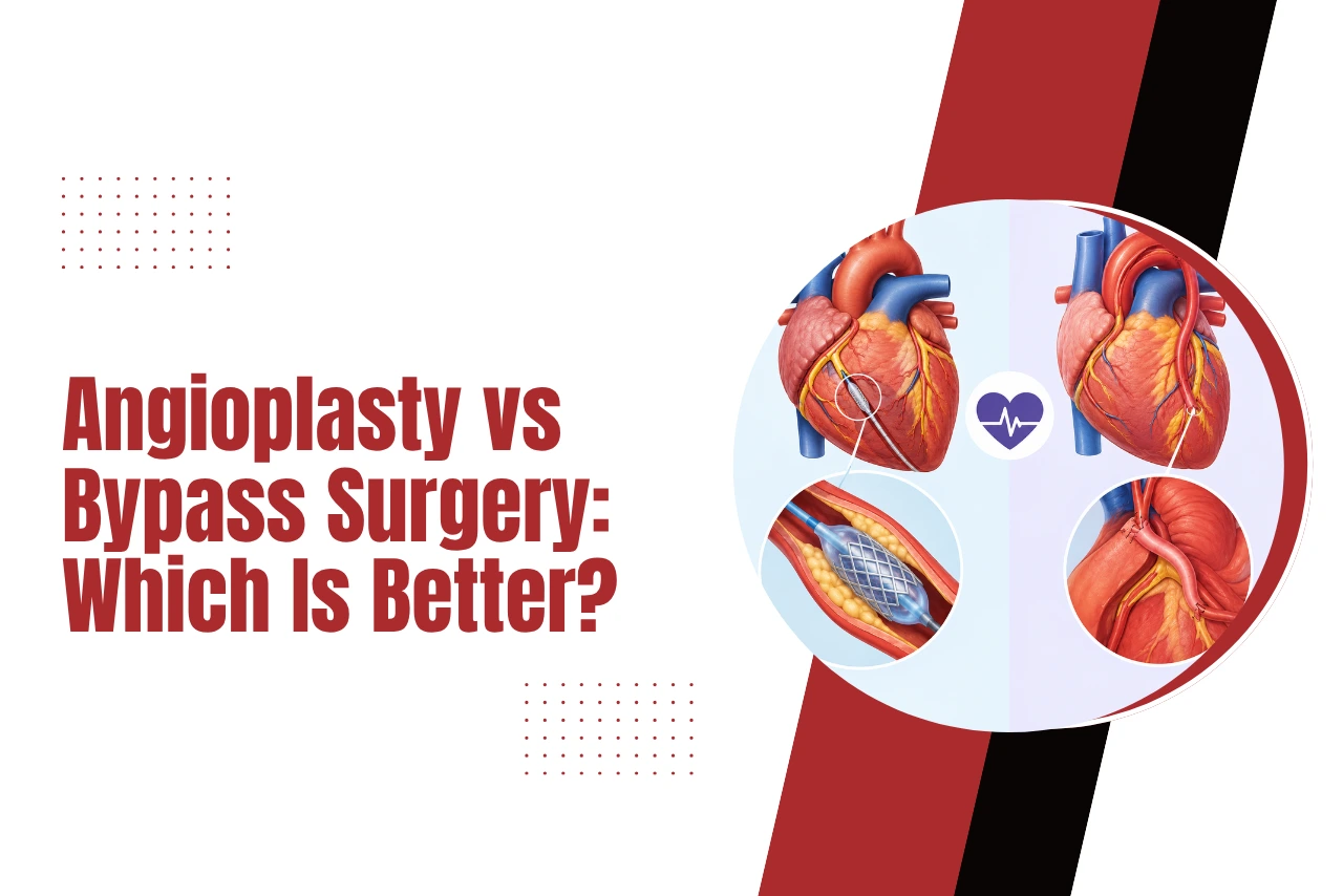 Angioplasty vs Bypass Surgery: Which Is Better? Angioplasty vs Bypass Surgery: Which Is Better?